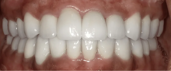 Full mouth reconstruction after treatment